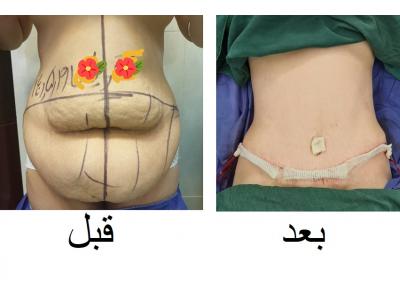 بدون دود-دکتر محمد گنجه جراح چاقی و پلاستیک ، جراحی کولورکتال و لاپاراسکوپی و بوتاکس معده