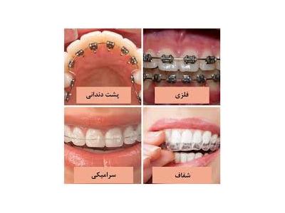 لمینت و-کلینیک دندانپزشکی دکتر محمدرضا معزز جراح ، دندانپزشک متخصص ایمپلنت در تهرانپارس